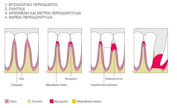 Περιοδοντίτιδα
