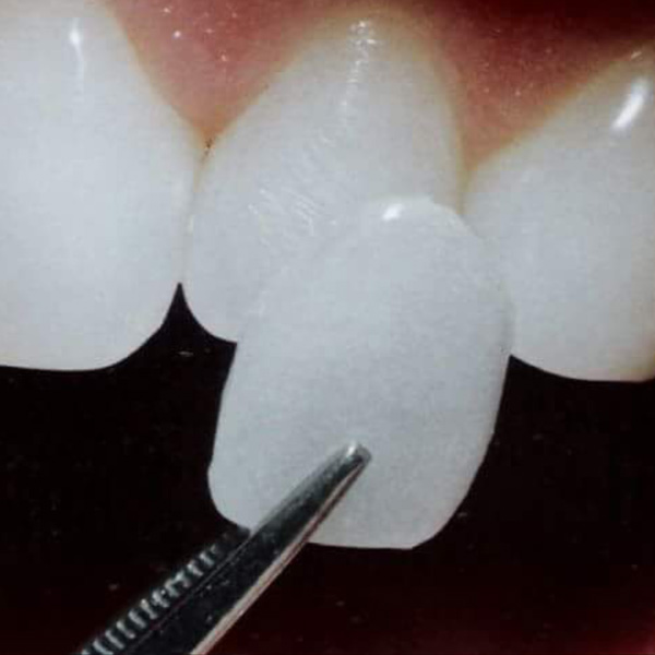 Porcelain veneers