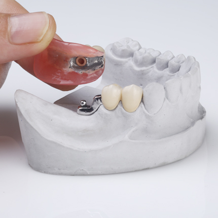 Removable dentures