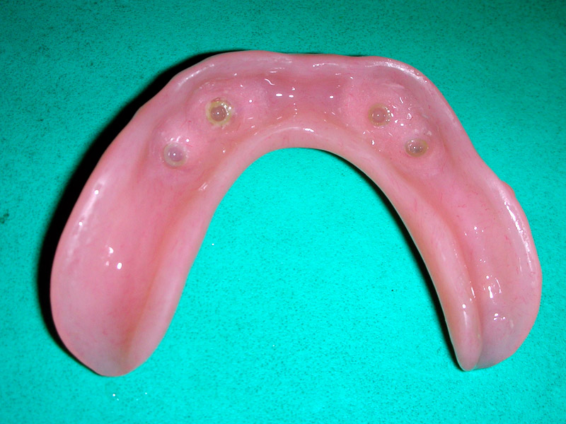 Removable dentures