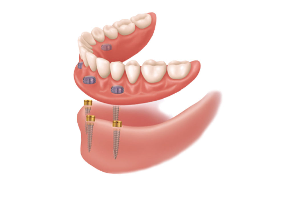 Removable dentures